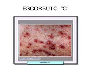 ESCORBUTO “C”
 