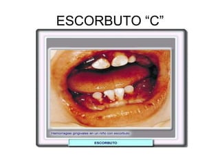 ESCORBUTO “C”
 
