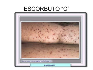 ESCORBUTO “C”
 