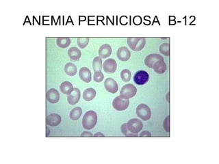 ANEMIA PERNICIOSA B-12
 
