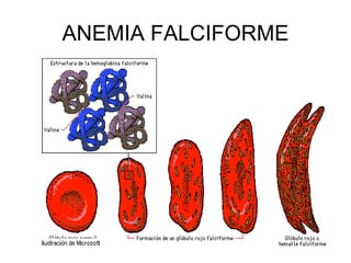 ANEMIA FALCIFORME
 
