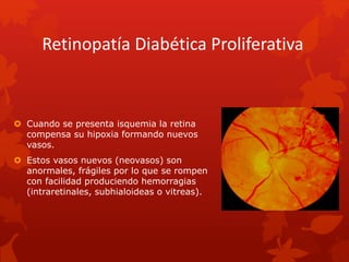 Retinopatía Diabética Proliferativa
 Cuando se presenta isquemia la retina
compensa su hipoxia formando nuevos
vasos.
 Estos vasos nuevos (neovasos) son
anormales, frágiles por lo que se rompen
con facilidad produciendo hemorragias
(intraretinales, subhialoideas o vitreas).
 