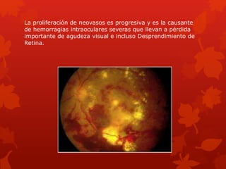 La proliferación de neovasos es progresiva y es la causante
de hemorragias intraoculares severas que llevan a pérdida
importante de agudeza visual e incluso Desprendimiento de
Retina.
 