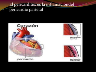 El pericarditis: es la inflamaciondel
pericardio parietal
 