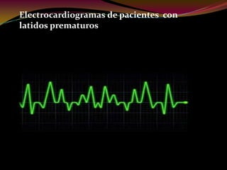 Electrocardiogramas de pacientes con
latidos prematuros
 