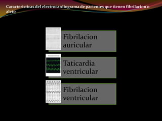Caracteristicas del electrocardiograma de pacientes que tienen fibrilacion o
aleto
Fibrilacion
auricular
Taticardia
ventricular
Fibrilacion
ventricular
 