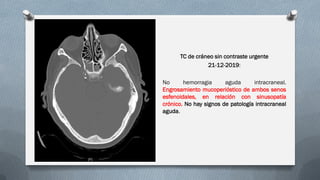 TC de cráneo sin contraste urgente
21-12-2019:
No hemorragia aguda intracraneal.
Engrosamiento mucoperióstico de ambos senos
esfenoidales, en relación con sinusopatía
crónico. No hay signos de patología intracraneal
aguda.
 