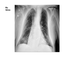 Rx
tórax
 
