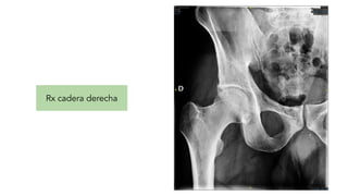 Rx cadera derecha
 