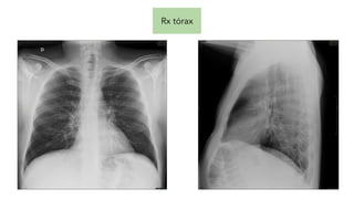 Rx tórax
 