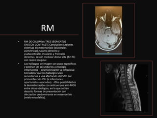 RM
• RM DE COLUMNA TRES SEGMENTOS
SIN/CON CONTRASTE Conclusión: Lesiones
extensas en mesencéfalo (bilaterales
asimétricas), tálamo derecho y
yuxtacorticales insulares y frontales
derechas. Lesión medular dorsal alta (T2-T3)
con realce irregular.
• Los hallazgos de imagen son poco específicos
y podrían ser secundarios a etiología
inflamatoria – desmielinizante vs infecciosa: -
Considerar que los hallazgos sean
secundarios a una afectación del SNC por
primoinfección VIH (e infecciones
oportunistas asociadas). - Otra posibilidad es
la demielinización con anticuerpos anti-MOG
entre otras etiologías, en la que se han
descrito formas de presentación con
afectación predominante en mesencéfalo
(mielo-encefalitis).
 