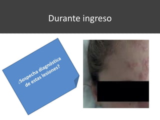Durante ingreso
• Aparición lesiones vesiculosas
periorbitarias y a nivel frontal
derecho, localizadas, sin
afectación palpebral, ptosis ni
edema.
 