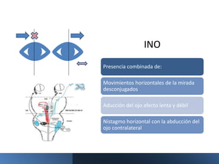 INO
Presencia combinada de:
Movimientos horizontales de la mirada
desconjugados
Aducción del ojo afecto lenta y débil
Nistagmo horizontal con la abducción del
ojo contralateral
 