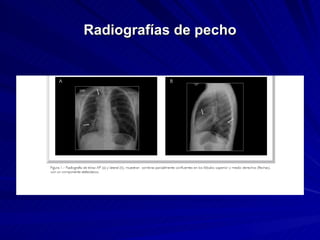 Radiografías de pecho 