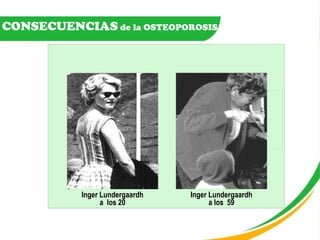 CONSECUENCIAS  de la OSTEOPOROSIS  Inger Lundergaardh a  los 20 Inger Lundergaardh a los  59 