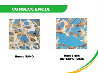 CONSECUENCIA Hueso SANO Hueso con OSTEOPOROSIS 