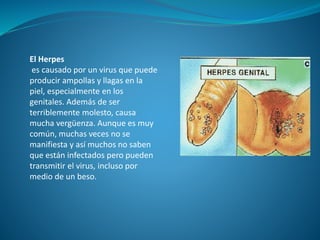El Herpes
es causado por un virus que puede
producir ampollas y llagas en la
piel, especialmente en los
genitales. Además de ser
terriblemente molesto, causa
mucha vergüenza. Aunque es muy
común, muchas veces no se
manifiesta y así muchos no saben
que están infectados pero pueden
transmitir el virus, incluso por
medio de un beso.
 
