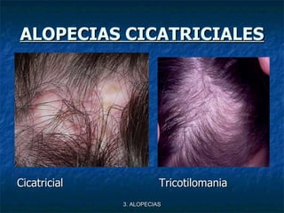 ALOPECIAS CICATRICIALES <ul><li>Cicatricial Tricotilomania </li></ul>3. ALOPECIAS 