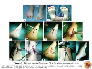 TRATADO DE PEDIATRIA DE NELSON; VOLUMEN I; 18VA EDICION; ELSEVIER FOUNDERS EDITORIAL; TRANSTORNOS DE LOS HUESOS 
Y ARTICULACIONES; CAPITULO 673; PIE EQUINOVARO; PAGINA 2777- 2780 
 
