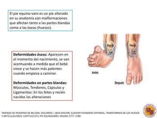 El pie equino-varo es un pie alterado 
en su anatomía con malformaciones 
que afectan tanto a las partes blandas 
como a las óseas (huesos). 
Deformidades óseas: Aparecen en 
el momento del nacimiento, se van 
acentuando a medida que el bebé 
crece y se hacen más patentes 
cuando empieza a caminar. 
Deformidades en partes blandas: 
Músculos, Tendones, Cápsulas y 
Ligamentos: En los fetos y recién 
nacidos las alteraciones 
TRATADO DE PEDIATRIA DE NELSON; VOLUMEN I; 18VA EDICION; ELSEVIER FOUNDERS EDITORIAL; TRANSTORNOS DE LOS HUESOS 
Y ARTICULACIONES; CAPITULO 673; PIE EQUINOVARO; PAGINA 2777- 2780 
 