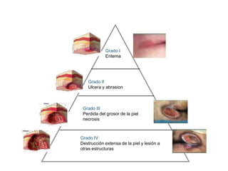 Grado I
Eritema
Grado II
Ulcera y abrasion
Grado III
Perdida del grosor de la piel
necrosis
Grado IV
Destrucción extensa de la piel y lesión a
otras estructuras
 