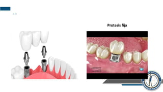 --
Protesis fija
 