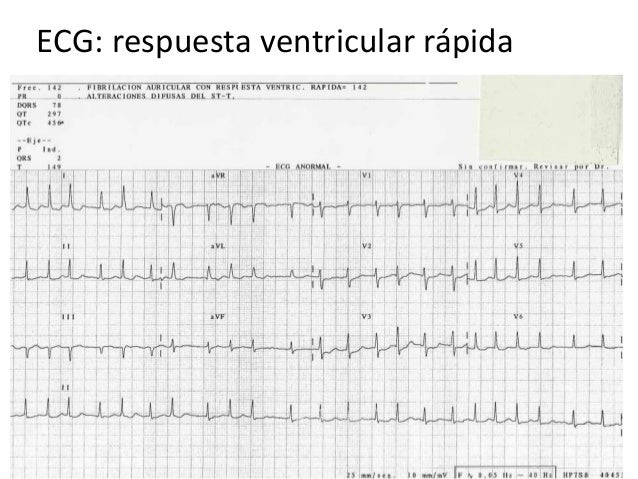 What Happens To Your Heart When You Don T Exercise What Happens To Your Heart When You Don T Exercise