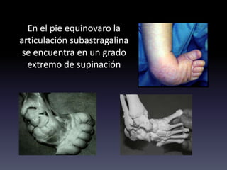En el pie equinovaro la
articulación subastragalina
se encuentra en un grado
extremo de supinación
 