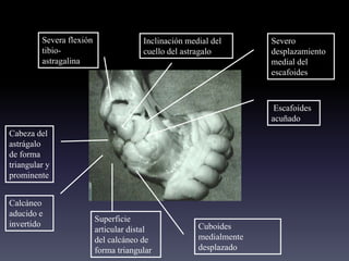 Inclinación medial del
cuello del astragalo
Severa flexión
tibio-
astragalina
Cabeza del
astrágalo
de forma
triangular y
prominente
Severo
desplazamiento
medial del
escafoides
Escafoides
acuñado
Calcáneo
aducido e
invertido
Superficie
articular distal
del calcáneo de
forma triangular
Cuboides
medialmente
desplazado
 