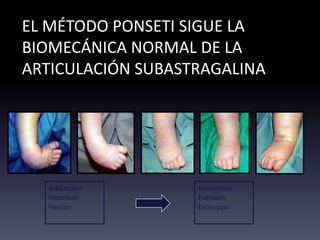 EL MÉTODO PONSETI SIGUE LA
BIOMECÁNICA NORMAL DE LA
ARTICULACIÓN SUBASTRAGALINA
Adduction
Inversion
Flexion
Abduction
Eversion
Extension
 