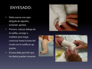 ENYESADO:
• Debe usarse una capa
delgada de algodón,
evitando apretar.
• Primero colocar debajo de
la rodilla, corregir y
moldear para luego
continuar hasta la base del
muslo con la rodilla en 90
grados.
• El yeso debe permitir que
los dedos puedan moverse
 