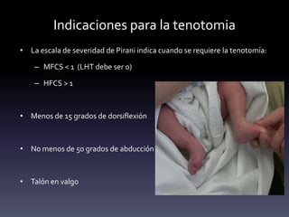 Indicaciones para la tenotomia
• La escala de severidad de Pirani indica cuando se requiere la tenotomía:
– MFCS < 1 (LHT debe ser 0)
– HFCS > 1
• Menos de 15 grados de dorsiflexión
• No menos de 50 grados de abducción del pie
• Talón en valgo
 