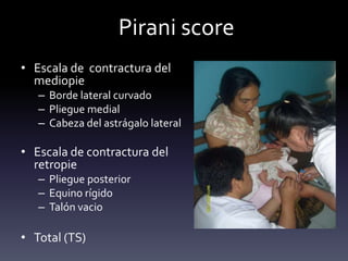 Pirani score
• Escala de contractura del
mediopie
– Borde lateral curvado
– Pliegue medial
– Cabeza del astrágalo lateral
• Escala de contractura del
retropie
– Pliegue posterior
– Equino rígido
– Talón vacio
• Total (TS)
 