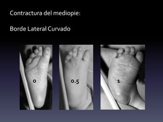 Contractura del mediopie:
Borde Lateral Curvado
0 0.5 1
 