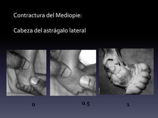 Contractura del Mediopie:
Cabeza del astrágalo lateral
0 0.5 1
 