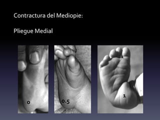 Contractura del Mediopie:
Pliegue Medial
0 0.5
1
 