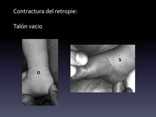 Contractura del retropie:
Talón vacio
0
1
 