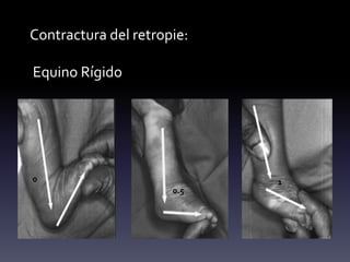 Contractura del retropie:
Equino Rígido
0
0.5
1
 