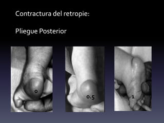Contractura del retropie:
Pliegue Posterior
0
0.5 1
 