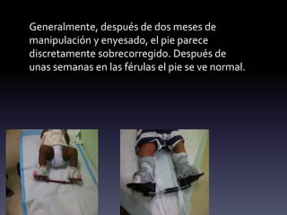 Generalmente, después de dos meses de manipula
Generalmente, después de dos meses de
manipulación y enyesado, el pie parece
discretamente sobrecorregido. Después de
unas semanas en las férulas el pie se ve normal.
 