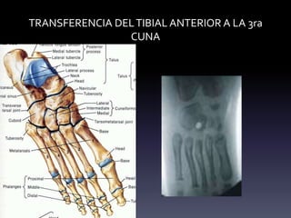 TRANSFERENCIA DELTIBIAL ANTERIOR A LA 3ra
CUNA
 