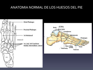 Dorsal
Plantar
ANATOMIA NORMAL DE LOS HUESOS DEL PIE
 