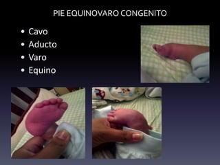 PIE EQUINOVARO CONGENITO
• Cavo
• Aducto
• Varo
• Equino
 