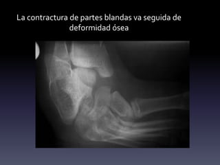 La contractura de partes blandas va seguida de
deformidad ósea
 