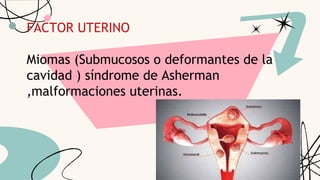 FACTOR UTERINO
Miomas (Submucosos o deformantes de la
cavidad ) síndrome de Asherman
,malformaciones uterinas.
 