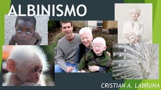 ALBINISMO
CRISTIAN A. LABRUNA
 