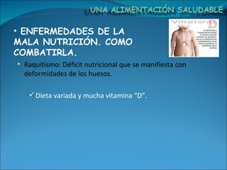 ENFERMEDADES DE LA MALA NUTRICIÓN. COMO COMBATIRLA. Raquitismo: Déficit nutricional que se manifiesta con deformidades de los huesos. Dieta variada y mucha vitamina “D”. 