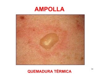 AMPOLLA QUEMADURA TÉRMICA 
