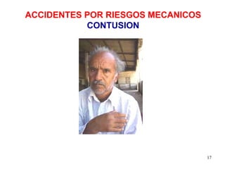 ACCIDENTES POR RIESGOS MECANICOS CONTUSION 