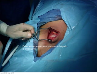 Debe ser generoso para que quede holgado
                          el dispositivo




jueves 24 de mayo de 12
 